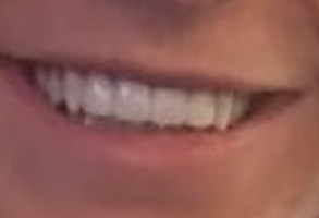 Blash Dentistry | Oral Exams, Crowns  amp  Caps and Implant Dentistry