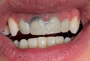 Blash Dentistry | Dentures, Oral Exams and Teeth Whitening