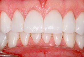 Blash Dentistry | Veneers, Implant Dentistry and Dental Fillings