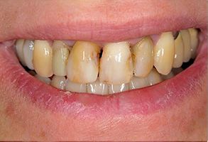 Blash Dentistry | Dentures, Oral Exams and Teeth Whitening