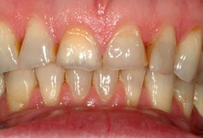 Blash Dentistry | Dentures, Teeth Whitening and Crowns  amp  Caps
