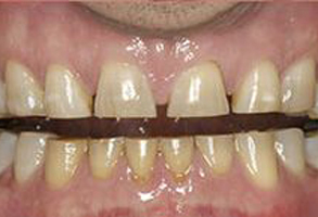 Blash Dentistry | Dental Bridges, Crowns  amp  Caps and Dental Fillings