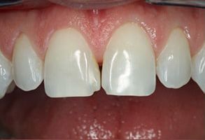 Blash Dentistry | Implant Dentistry, Dentures and Teeth Whitening